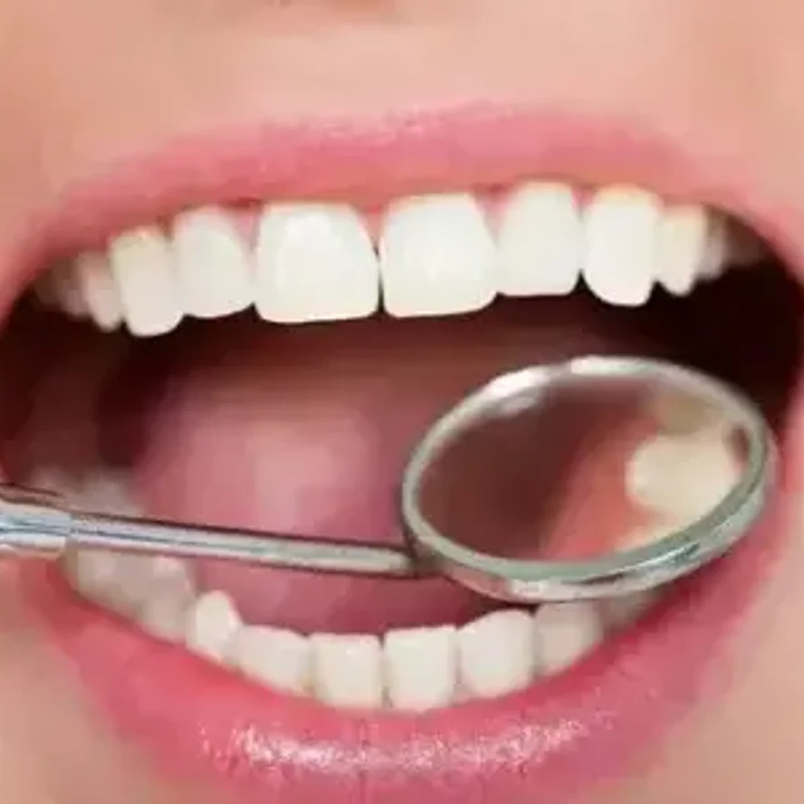 Телескопичекский протез на 4 импланта (все на четыре)